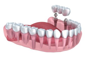 Dental implants visualization