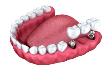Dental implants visualization
