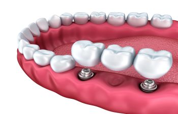 Dental implants visualization