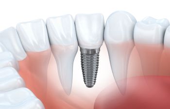 Dental implants visualization