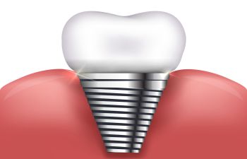 Dental implants visualization