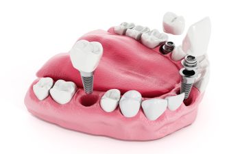 Dental implants visualization