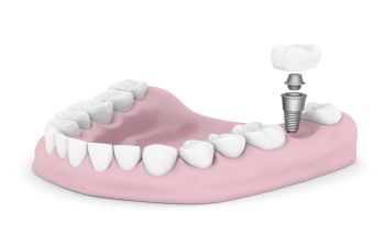 Dental implants visualization