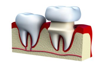 Dental implants visualization