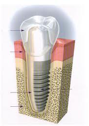Implant ilustration