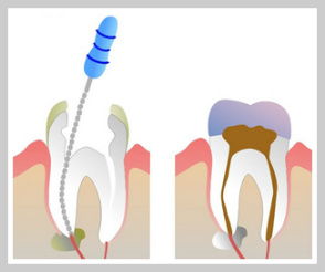 root canals