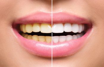 Whitening Teeth Roswell GA