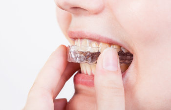 woman puts invisalign, 