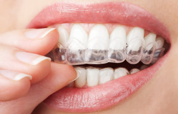 woman puts on invisalign close up on lips 1, 